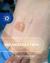 Κοιλιοπλαστική